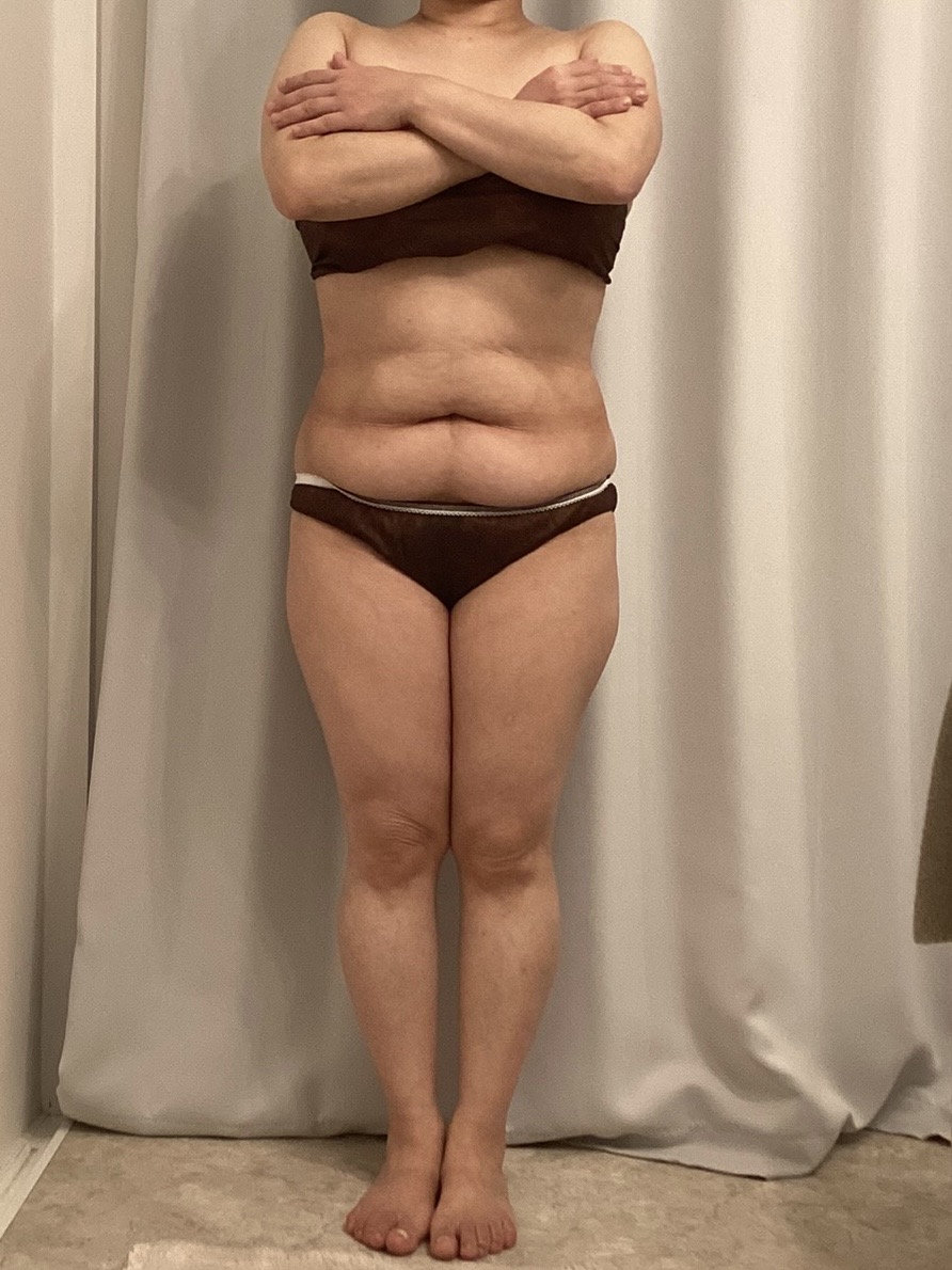 広島・安佐南区の痩身ダイエット最新事例：施術開始1ヶ月目のビフォー写真（Luana＋）