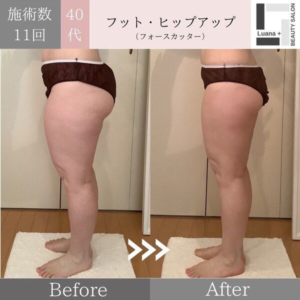 広島・安佐南区の痩身ダイエット事例：フット（脚やせ）