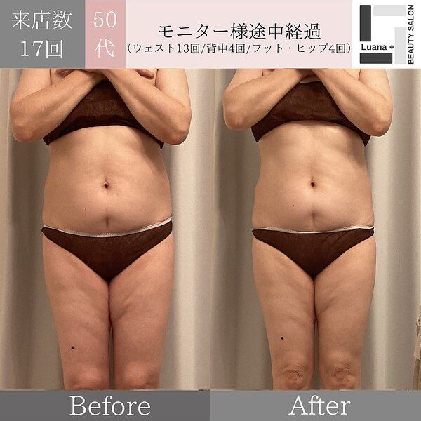 広島・安佐南区の痩身ダイエット事例：全身燃焼・モニター様