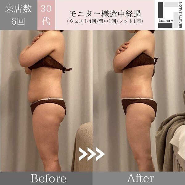 広島・安佐南区の痩身ダイエット事例：結果の出る痩身