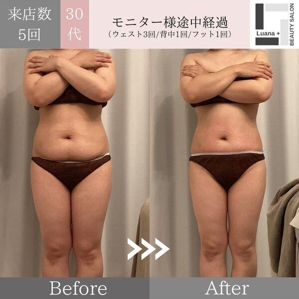 広島・安佐南区の痩身ダイエット事例：結果の出る痩身
