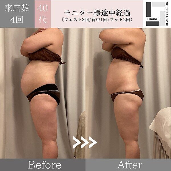 広島・安佐南区の痩身ダイエット事例：長年のお悩みに